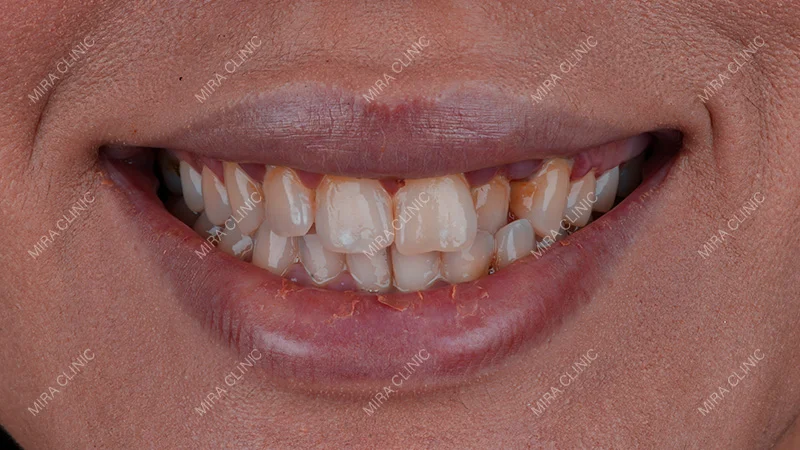 Saida Received Both E-max Veneers and Crowns